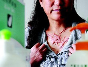 完美保健品致女子大面积溃烂(图) 