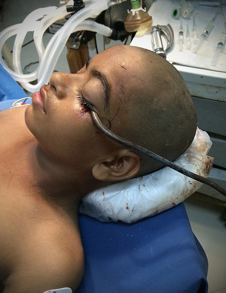 印男孩不慎将铁钩戳进左眼 入颅腔15公分