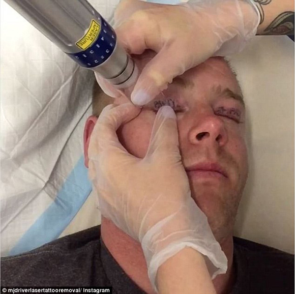 澳男子酗酒狂欢72小时候后清醒 发现眼皮遭刺青