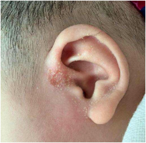 外耳道湿疹都会出现什么症状?日常护理四大注意事项