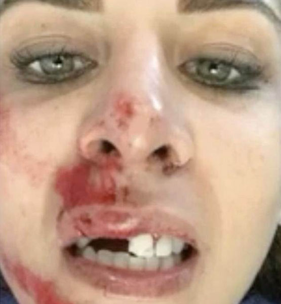 西班牙一女子玩蹦极遇事故 门牙磕碎血流满面