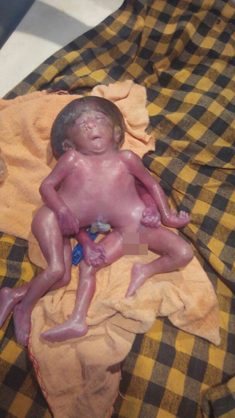 印度母亲诞下连体女婴 出生不久便夭折