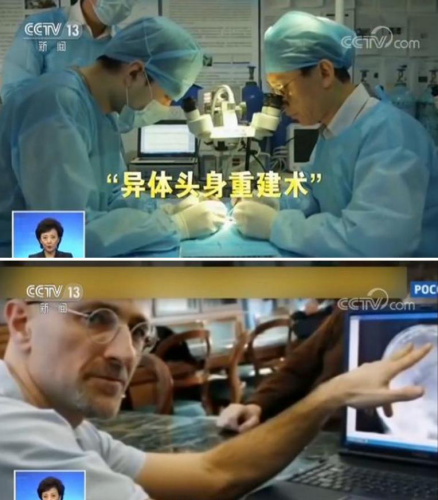 中国哈尔滨医科大学任晓平教授,曾在2016年成功进行了猴子换头手术.