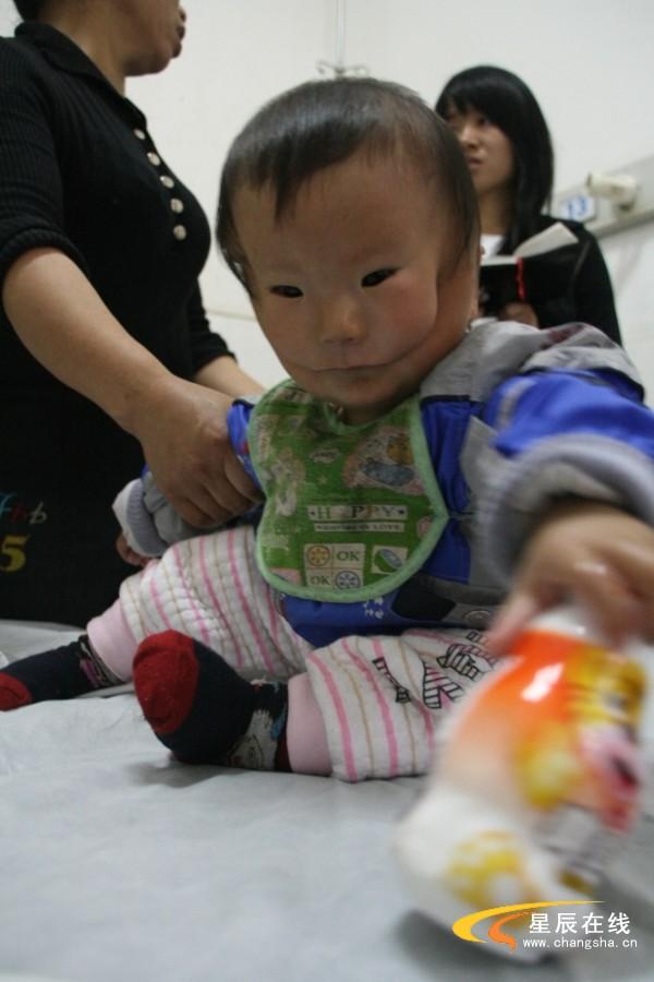 畸形婴儿成了极为罕见的“面具娃娃”