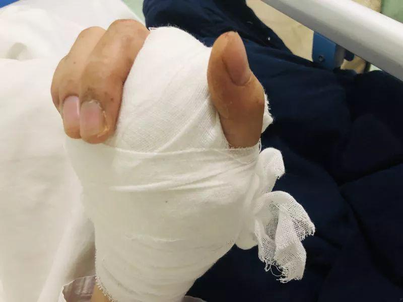23岁小伙在家拧螺丝手起泡 手指头感染最终被截指