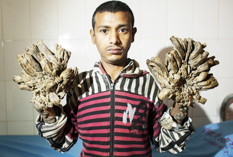 孟加拉国男子患怪病 手脚增生如树根