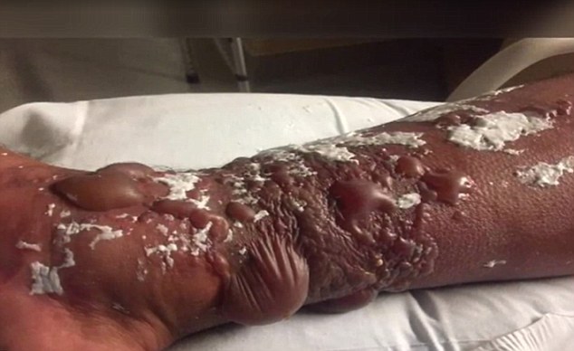 创伤弧菌脓毒症大鼠肺组织脂多糖受体cd14 mrna,核因子-κb的基因动态