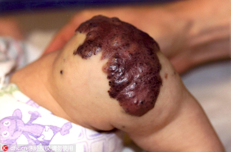 美宝宝患血管畸形膝盖肿大如足球