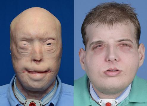 真人版大变脸美国一毁容消防员换脸成功