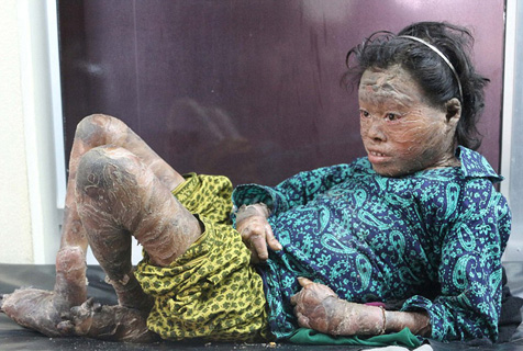 美女子暴瘦松皮垂落似沙皮狗 花78万整形变身小腰精