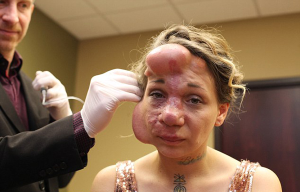 美女子因面部动静脉畸形毁容术后重获新生