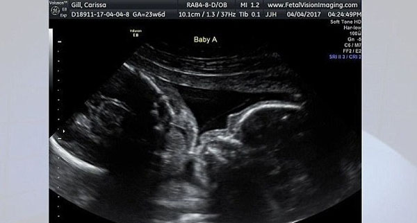 双胞胎b超图 早孕图片
