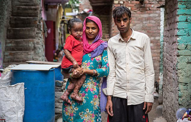 印度两岁女童莎玛(shama)患上了一种罕见的怪板层状鱼鳞病,这使得她的