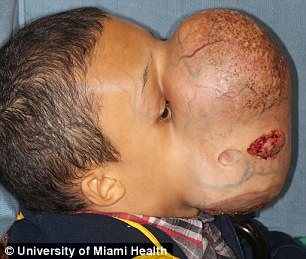 古巴14岁男孩脸上长10磅重肿瘤!