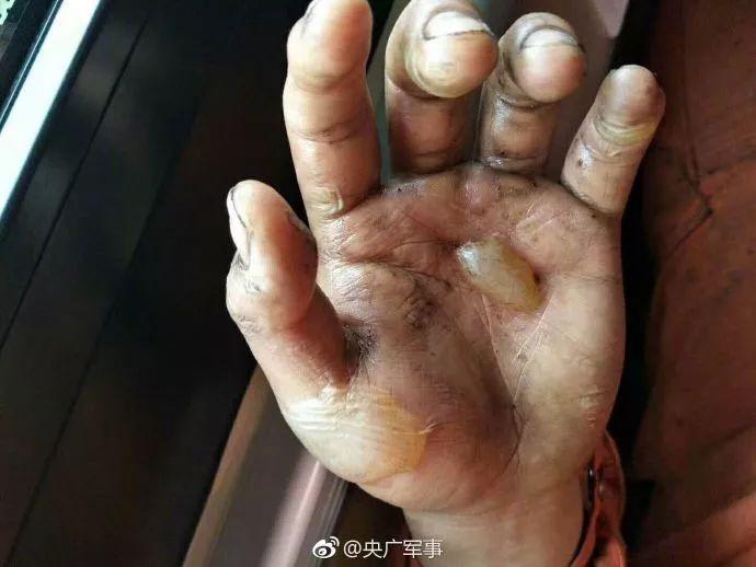 这只手的照片让15万网友点赞无数人心疼